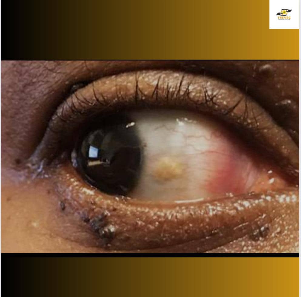 Yellowish nasal growth of Pinguecula in the eye