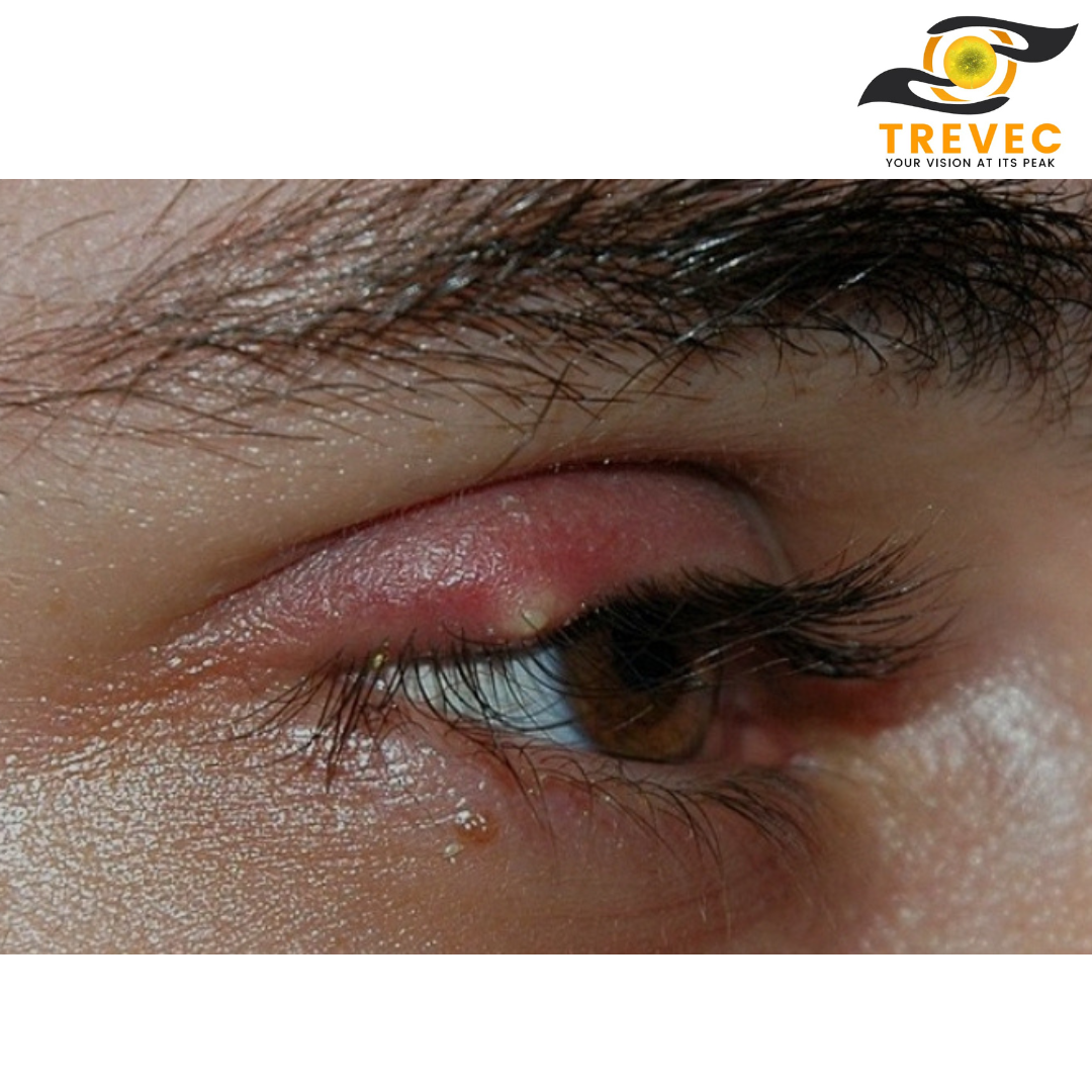 Stye,a symptom of eye issues.